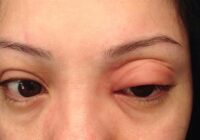 EMITE IMSS VERACRUZ SUR RECOMENDACIONES PARA EVITAR LA ENFERMEDAD DE CHAGAS