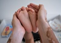 Afecta vitíligo en mayor medida a mujeres: IMSS Veracruz Sur