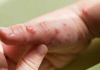 Veracruz tiene tres casos confirmados de viruela del mono