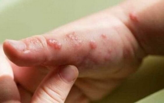 Veracruz tiene tres casos confirmados de viruela del mono