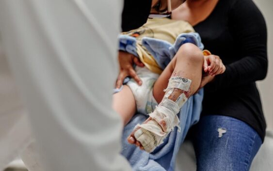 Con injerto de piel cultivada, IMSS Chiapas ayuda a recuperación de pacientes quemados