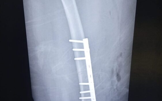 Ofrece Centro de Seguridad Social del IMSS Veracruz Sur atención a pacientes crónico degenerativos