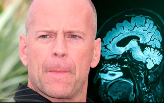 Bruce Willis es diagnosticado con demencia frontotemporal: ¿Qué es y cuáles son sus síntomas?