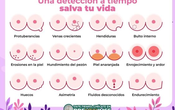 Recomienda IMSS Veracruz Sur autoexploración, herramienta para prevenir cáncer de mama