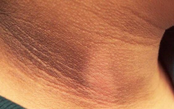 Explica IMSS Veracruz qué es y por qué salen manchas negras en el cuello