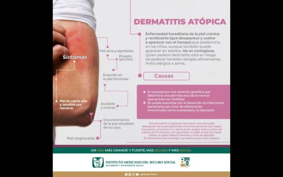 Informa IMSS Veracruz Sur sobre síntomas de dermatitis atópica