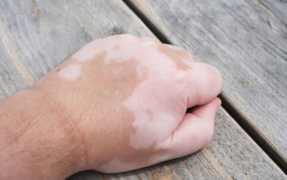 Informa IMSS Veracruz Sur sobre vitíligo y sus causas