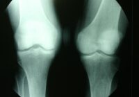 Informa IMSS Veracruz sobre osteoporosis