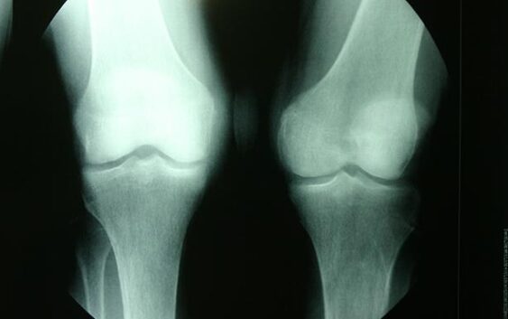 Informa IMSS Veracruz sobre osteoporosis