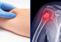 Orienta IMSS Veracruz Sur sobre detección oportuna del sarcoma