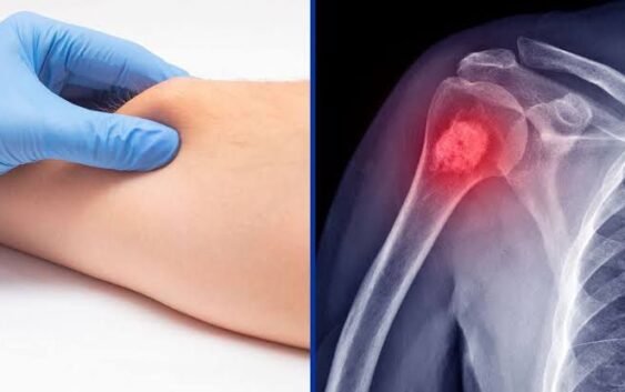 Orienta IMSS Veracruz Sur sobre detección oportuna del sarcoma