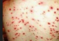 BROTE DE VARICELAS EN AGUA FRIA CHICONTEPEC