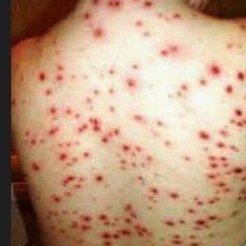 BROTE DE VARICELAS EN AGUA FRIA CHICONTEPEC