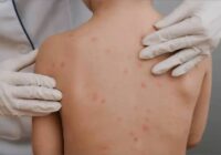 Se disparan los casos de varicela