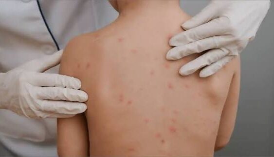 Se disparan los casos de varicela