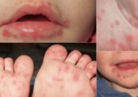 Con higiene se previene el Coxsackie; puede derivar en padecimientos graves, advierte la epidemióloga Ana Yee