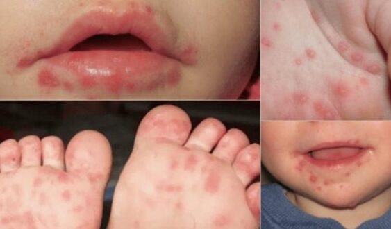 Con higiene se previene el Coxsackie; puede derivar en padecimientos graves, advierte la epidemióloga Ana Yee