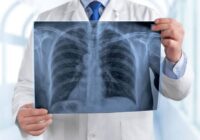 Refuerza IMSS Veracruz Sur acciones preventivas en marco del Día Mundial de la Neumonía