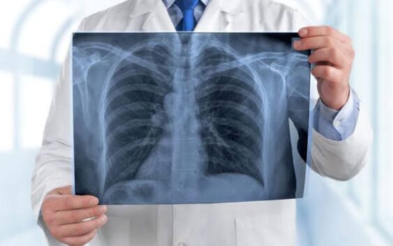 Refuerza IMSS Veracruz Sur acciones preventivas en marco del Día Mundial de la Neumonía