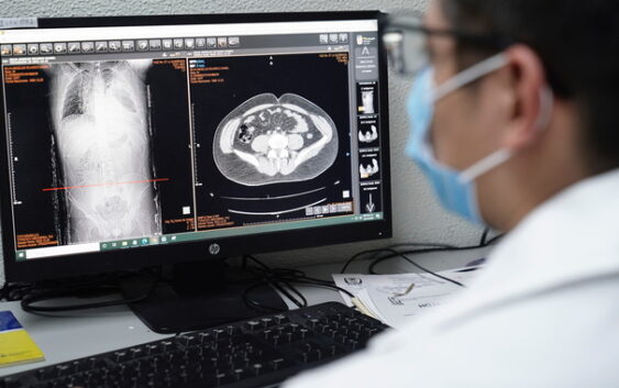 Impulsa IMSS Veracruz Sur prevención y detección oportuna de EPOC