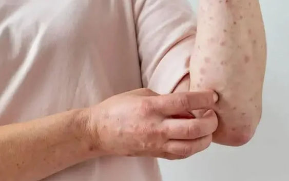 México acumula 24 muertes y casi 6 mil casos de sarampión