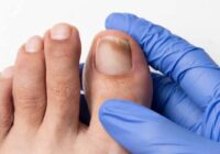 Pide IMSS Veracruz Sur evitar automedicación y remedios caseros para tratar hongos en uñas