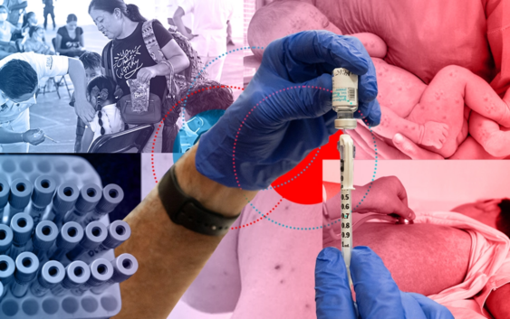 México cerró 2025 con el mayor brote de sarampión