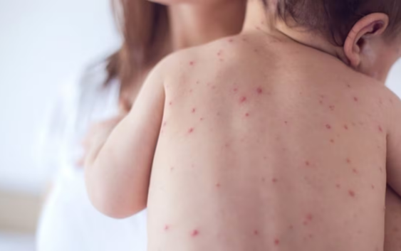 No vacunado: decisiones y omisiones de Estado que cobran vidas humanas