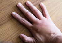 Exhorta IMSS Veracruz Sur a prevenir la retención de líquidos