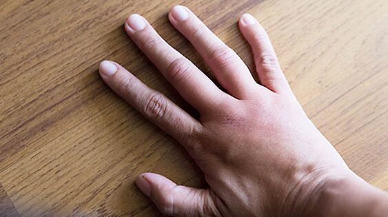 Exhorta IMSS Veracruz Sur a prevenir la retención de líquidos