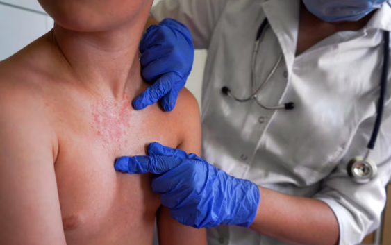 Un contagio por hora: la epidemia de sarampión que México no pudo frenar