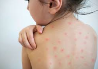 Maestra revela más de 20 casos de niños con sarampión en la comunidad de Rio Encajonado, Guerrero.