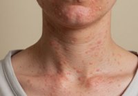 Aumentan casos de sarampión en México; ya van tres reconocidos en Veracruz