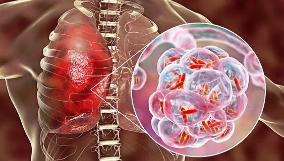 Llama IMSS Veracruz Sur a detección oportuna para frenar tuberculosis