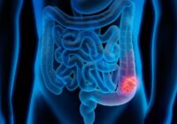 Prevenible el cáncer de Colón: IMSS Veracruz Sur
