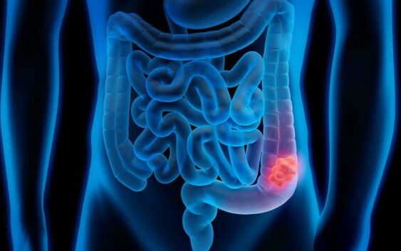 Prevenible el cáncer de Colón: IMSS Veracruz Sur