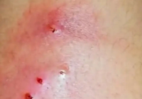 Confirman la primera muerte por miasis humana en esta entidad. Estos son los síntomas