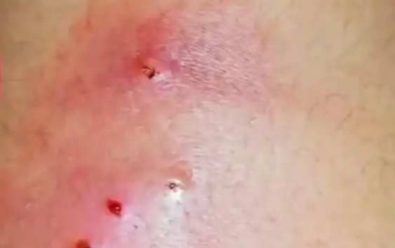 Confirman la primera muerte por miasis humana en esta entidad. Estos son los síntomas