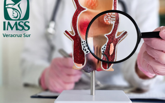 Recomienda IMSS Veracruz Sur hábitos saludables para combatir hemorroides